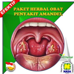 obat amandel nasa