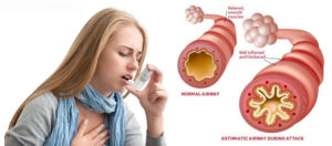 cara mengobati asma